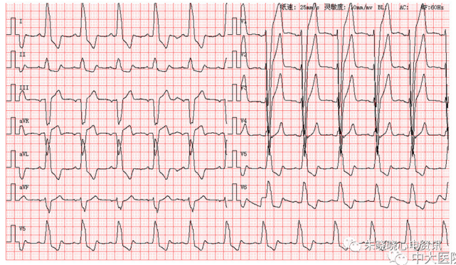 每日读图第1541期完全性左束支传导阻滞