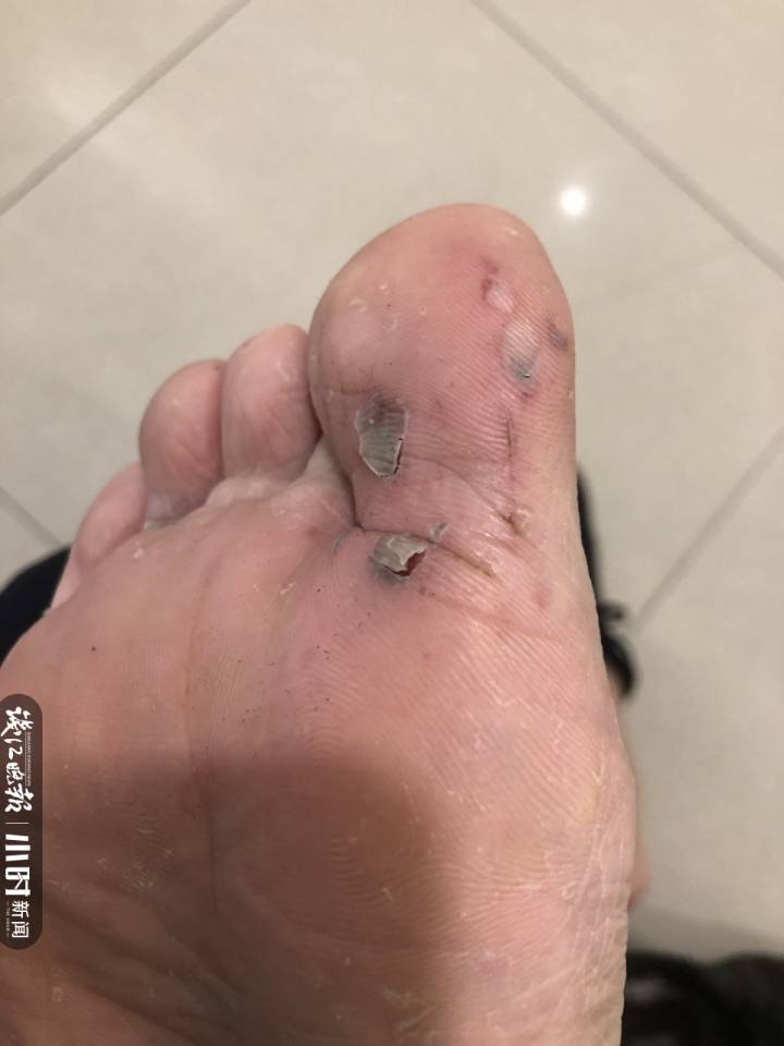 记者找到黎敏的时候,他正在处理伤口:"跳得太急了,两只脚都受伤了