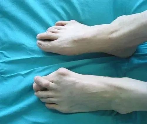 如果拇外翻严重,第二趾还可被拇趾挤向背侧,形成骑跨,出现锤状趾,常