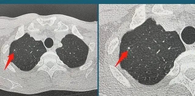 極易發展成肺癌的肺結節
