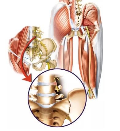 這些症狀很可能是腰椎管狹窄症,避免馬尾神經損傷,早診斷早治療!