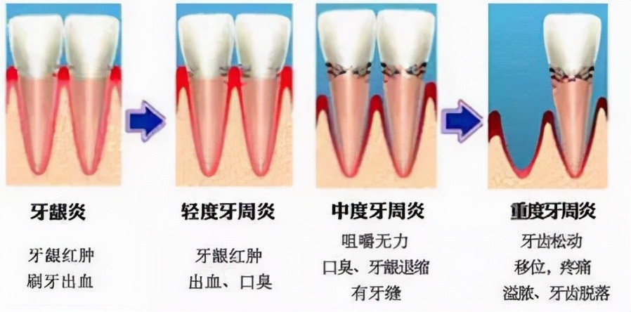 牙龈炎和牙周炎虽只是一字之差但区别很大