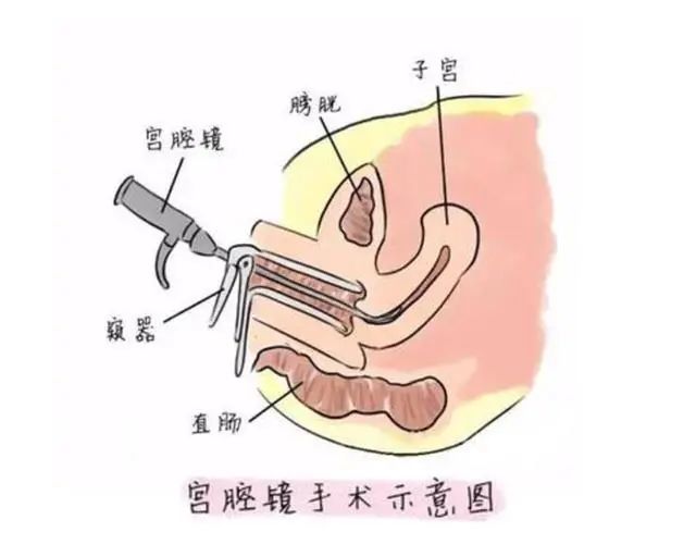 子宫内膜息肉——生命摇篮的不速之客