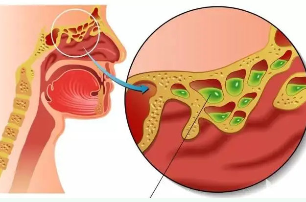 鼻腔检查时,则会明显发现:鼻腔内有大量脓性分泌物,鼻腔粘膜红肿,糜烂