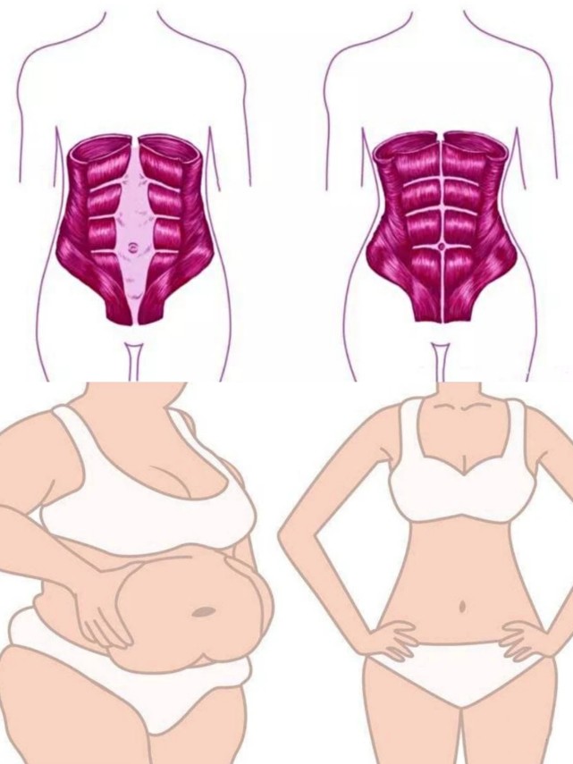 腹直肌分离与正常状态下的对比图