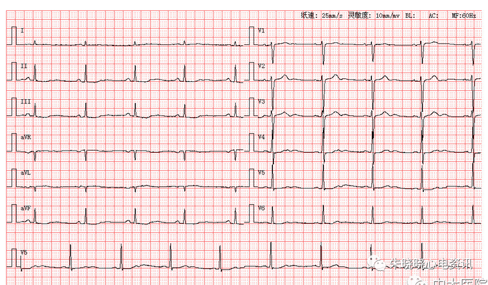 每日读图第1542期窦性心动过缓sttu异常