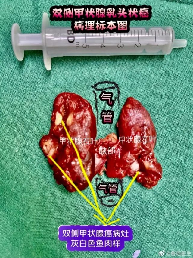 甲状腺乳头状癌|甲状腺|病灶|甲状腺癌|甲状腺多发结节|甲状腺b超