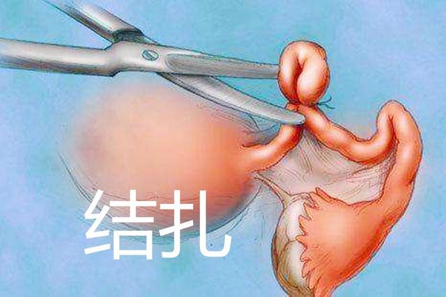 曾临床数据显示,有过输卵管结扎及手术史者,输卵管妊娠的发生率是10