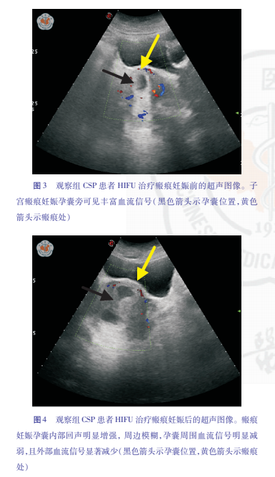 高强度超声聚焦对剖宫产瘢痕部位妊娠的治疗效果