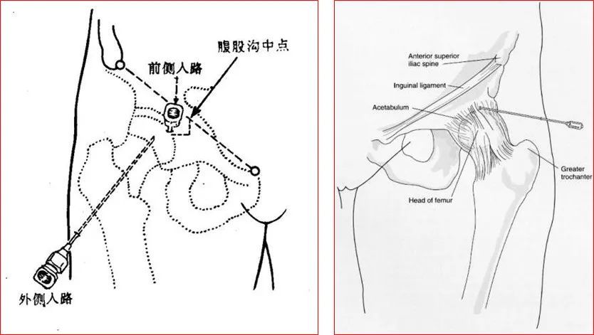 12种关节腔穿刺方法你都掌握了吗