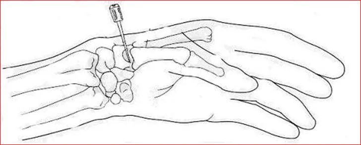 12种关节腔穿刺方法你都掌握了吗