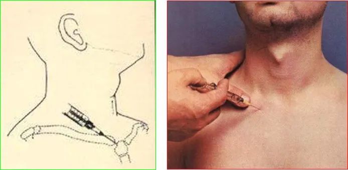 12种关节腔穿刺方法你都掌握了吗
