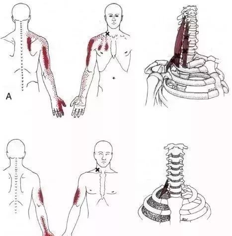 成功地找到並治療斜角肌的激痛點主要取決於你對斜角肌與胸鎖乳突肌