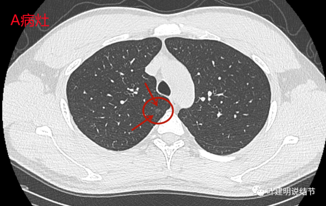 位置左上葉舌段,伴有中間小空泡的微小磨玻璃結節,密度甚低,同樣瘤肺