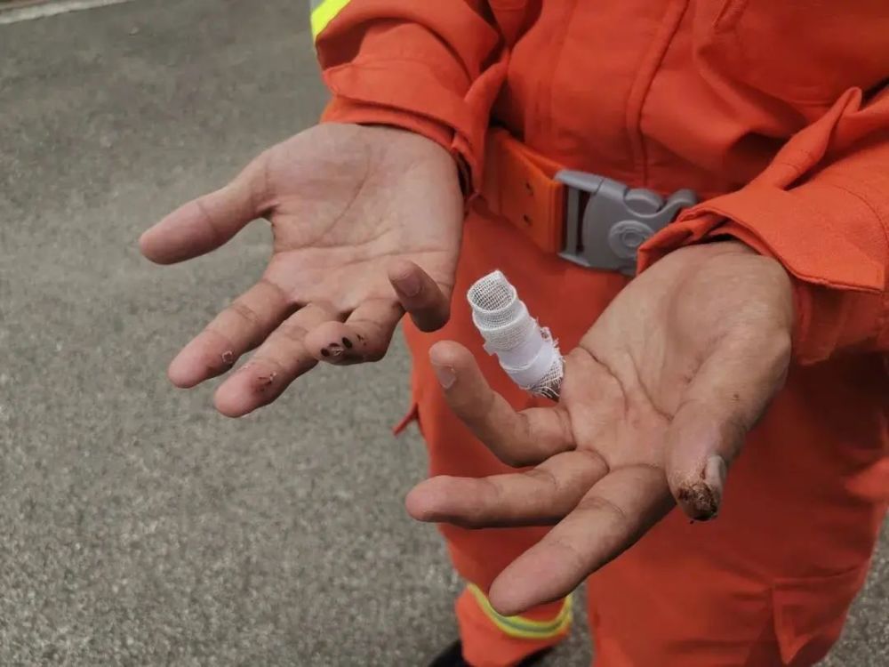 消防员张志顺的手