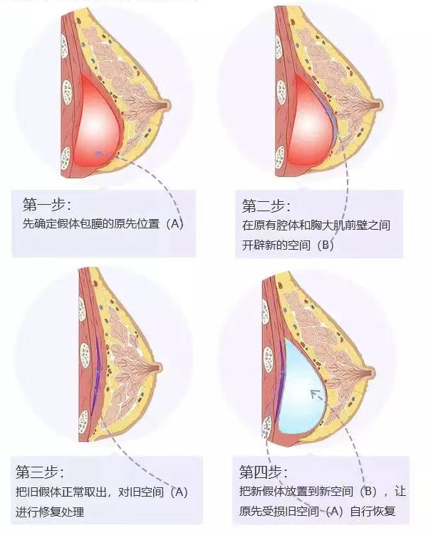 科普篇|胸部假體取出及修復