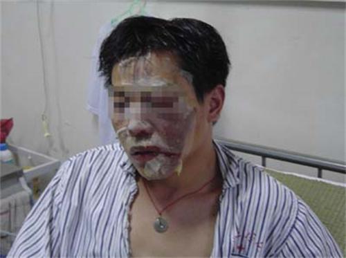 重庆19岁少年与女友分手后被泼硫酸面部毁容眼睛永远无法闭合