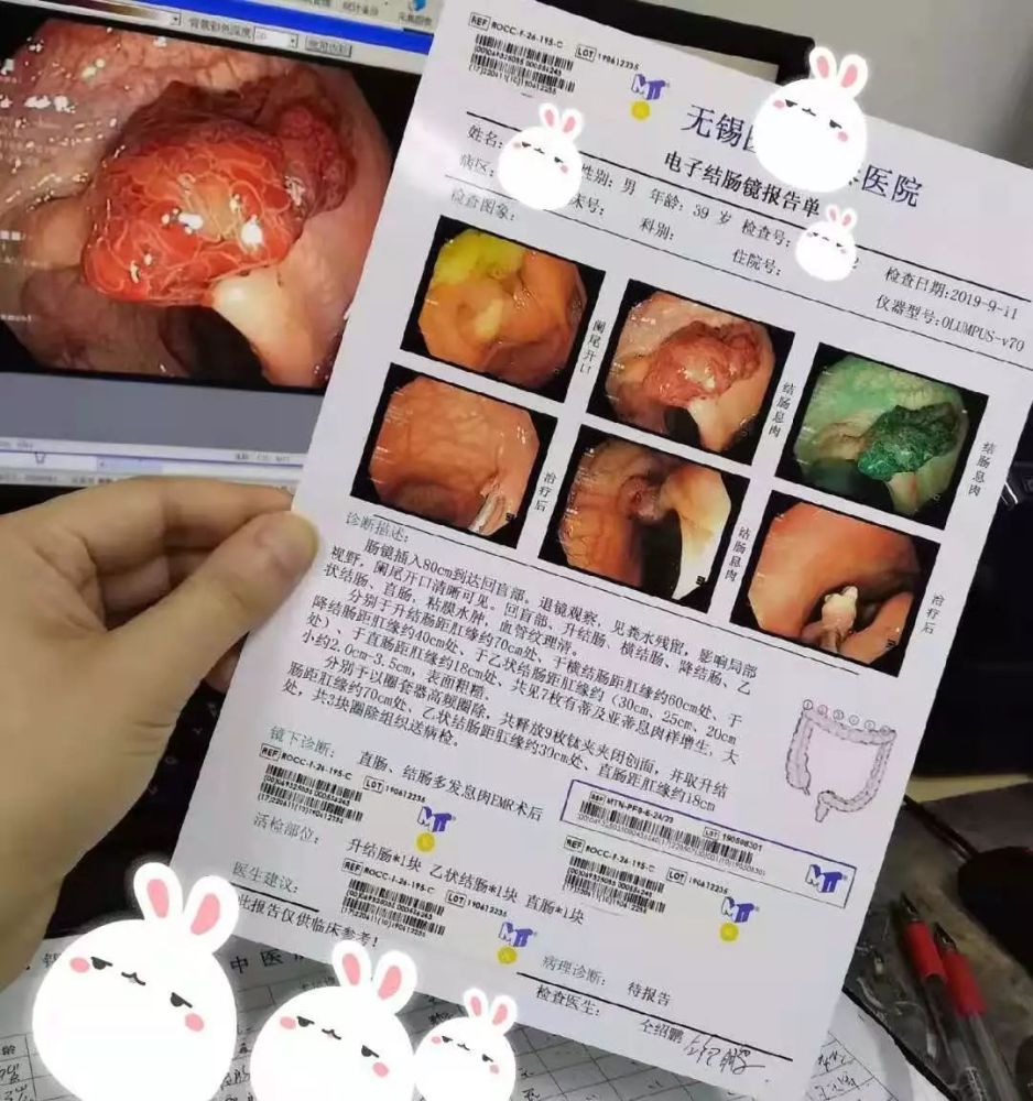 多發性腸息肉瞭解一下