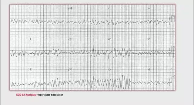 读图训练突发室颤这样处理最有效