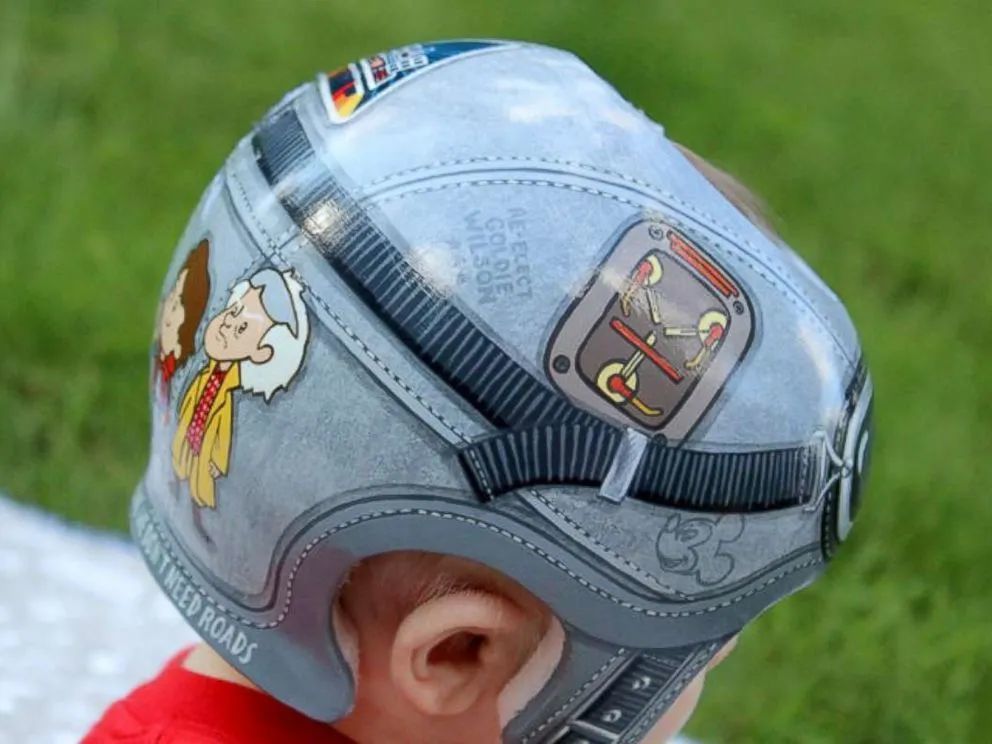 婴儿每天23小时戴矫正头盔能养出完美头型