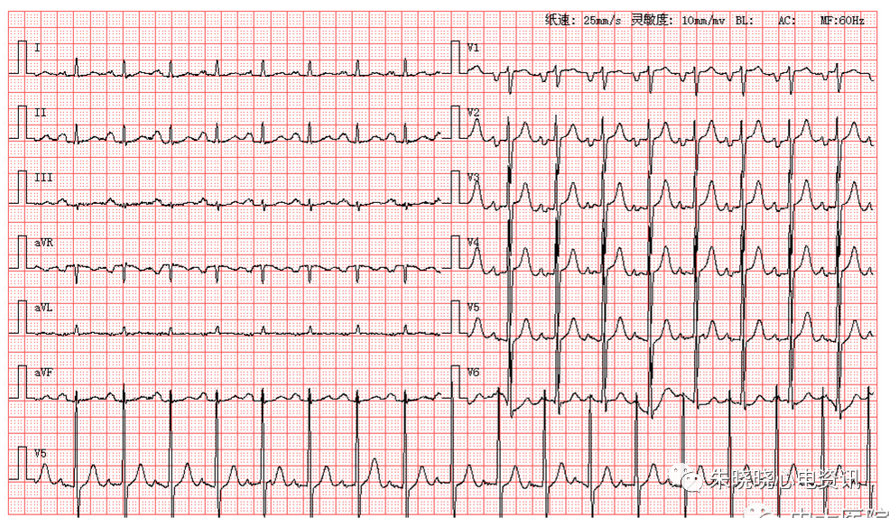 每日读图|第1544期 窦速 二尖瓣型p波 左心室高电压 一度房室传导阻滞