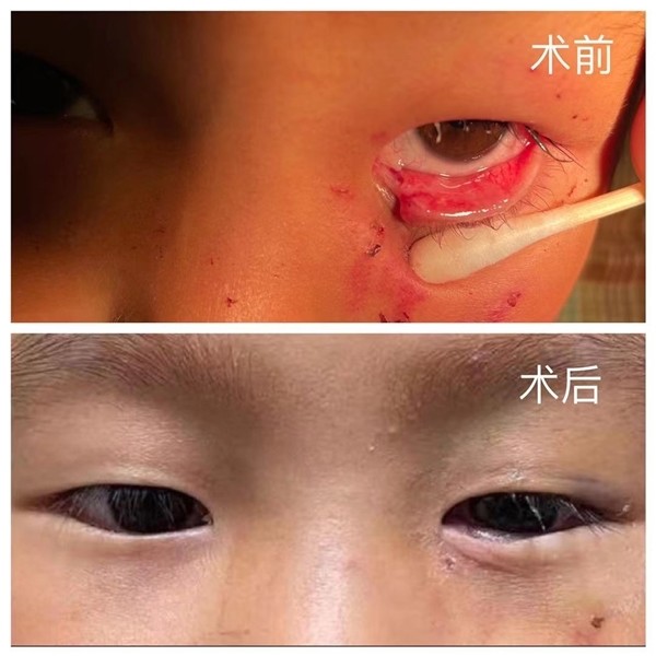 如果该处皮肤断裂那么手术效果将不会太好