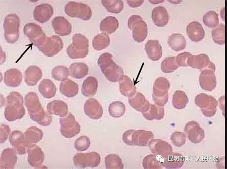 关于交叉配血中常见的凝集反应你了解吗