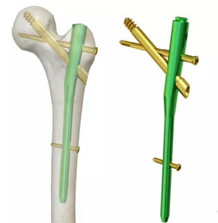 荔湾老年髋部骨折再添微创神器股骨近端仿生髓内钉pfbn张英泽院士亲临