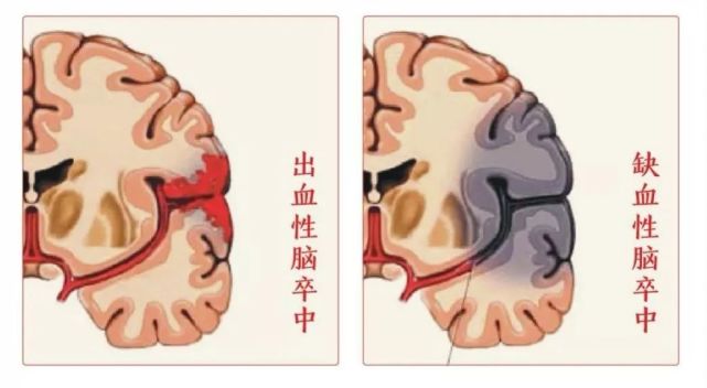 世界卒中日科學防治腦卒中您需要注意這些