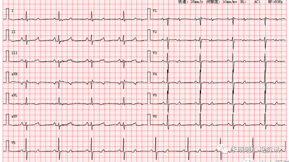 每日读图|第1544期 窦速 二尖瓣型p波 左心室高电压 一度房室传导阻滞