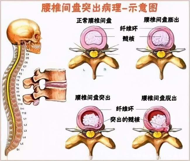 腰疼腿麻是腰椎间盘突出症吗