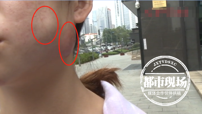 女子花万元注射玻尿酸,脸上长出大肿块,玛恩医疗美容医院被投诉_腾讯