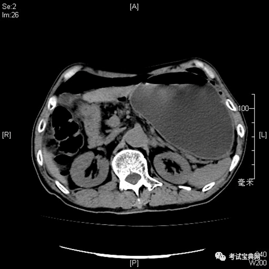 (1) 腹部ct:膈下多發遊離氣體,考慮胃竇部穿孔機會大.輔助檢查t:38.