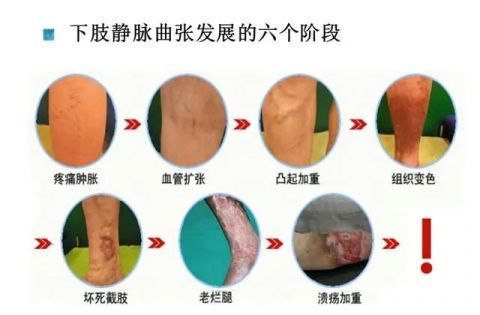 为什么静脉曲张会找上门,有什么危害?"老