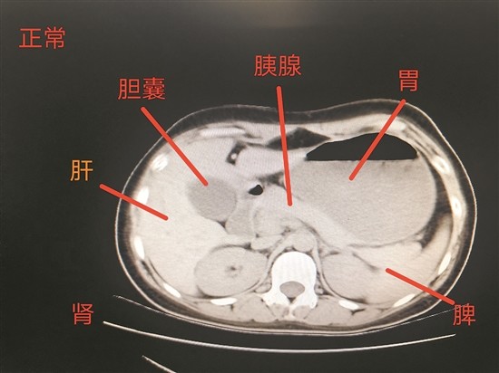 泉州一膽結石患者心在右肝在左醫生逆向手術