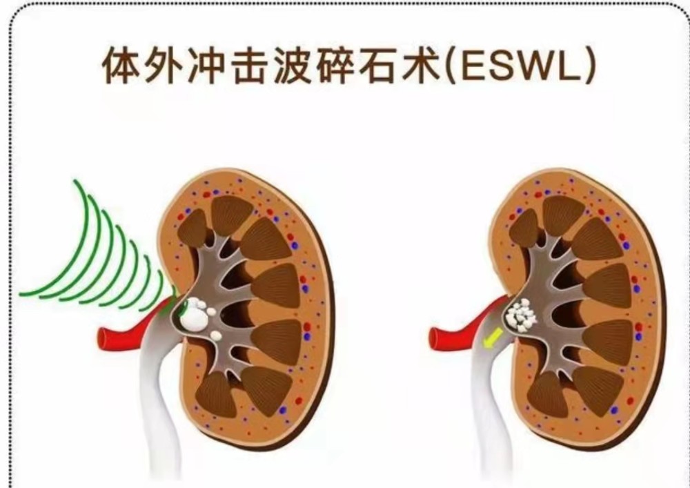 哪些肾结石可以行体外震波碎石治疗