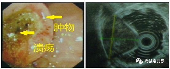 案例分析-胃間質瘤