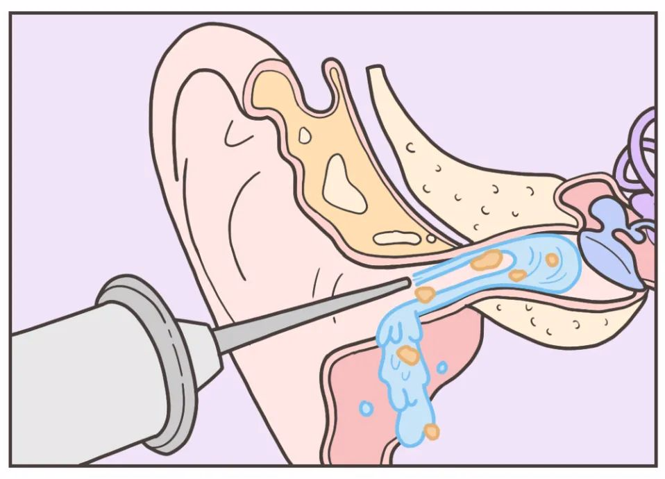 耵聍栓塞取出图片