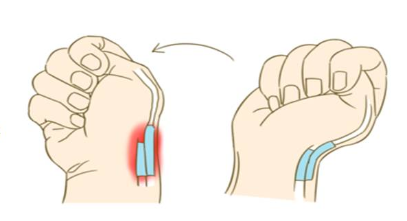 大拇指隐隐作痛?当心患上"妈妈手"