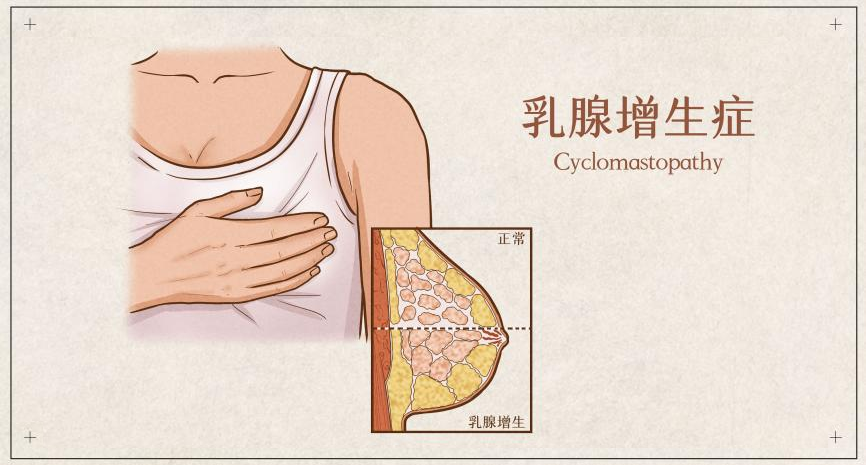 查出乳腺結節,就離癌症不遠了麼?_騰訊新聞