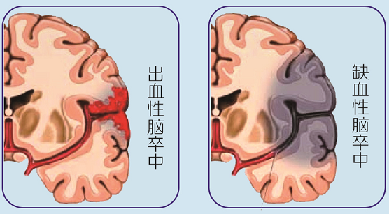 通常分为缺血性脑卒中(即脑梗死)和出血性卒中(即脑出血,蛛网膜下腔