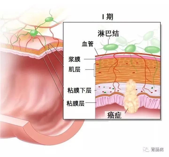 巨结肠分型图片