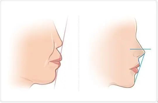 牙齿前突是怎么造成的?不矫正有危害吗?矫正效果好吗?