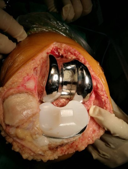 新"膝盖"会更好医生指出,膝关节是下肢重要的负重关节,也是人体最大