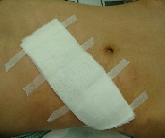 骨科精读|骨外科伤口换药,做好这几个细节事半功倍!