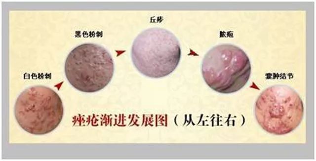 你的痘印痘坑痘疤还在吗痘肌治疗思路