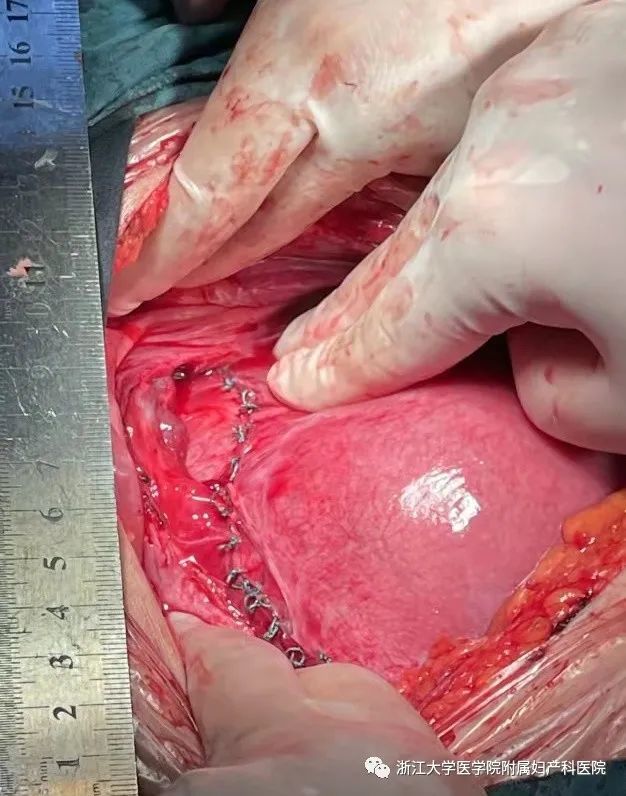 孕期过半子宫瘢痕裂开,宝宝一脚就能"踢出"子宫——浙大妇院创造了
