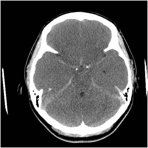 橫斷位非增強 ct 掃描顯示大腦彌散性低密度,灰白質分界不清,腦溝模糊