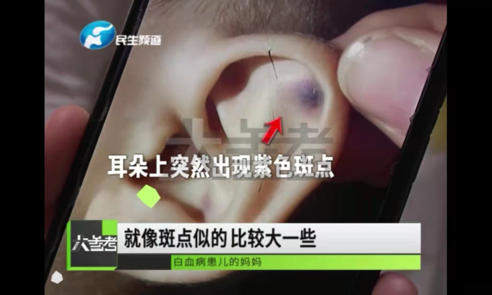 较真男童身上有紫色斑点被查出白血病家长们孩子有这4个症状要警惕