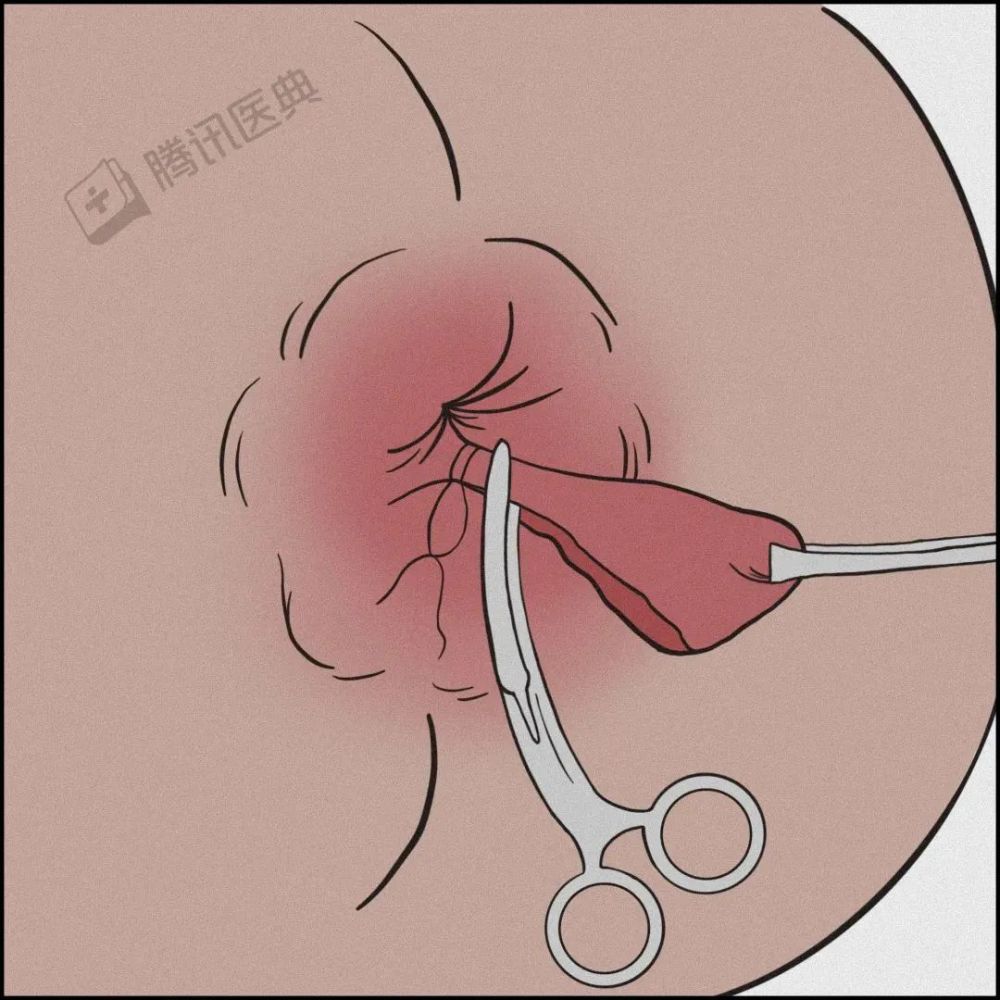 有痔疮的人将经历什么附上最全菊花呵护宝典